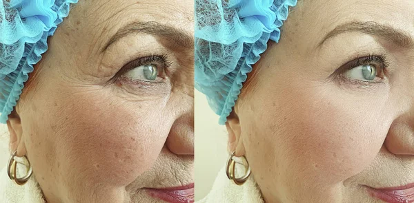 Yaşlı Kadın Yüz Önce Tedavi Sonrası Kırışıklıkları — Stok fotoğraf