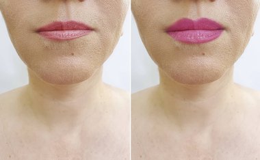 Kadın dudakları büyütme öncesi ve sonrası