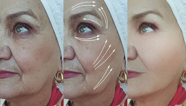 Wanita Tua Wajah Keriput Sebelum Dan Setelah Pengobatan Panah — Stok Foto