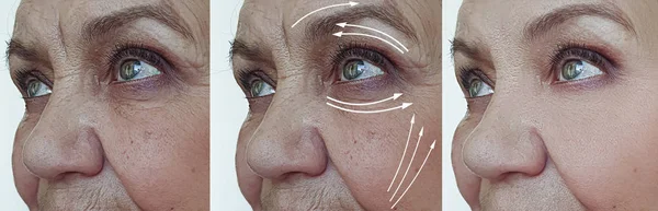 Elderly Woman Face Wrinkles Treatment Arrow — Stock Photo, Image