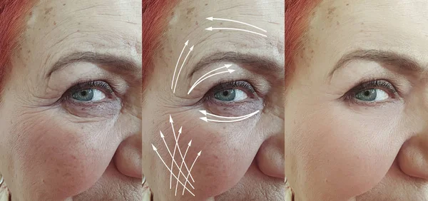 Ηλικιωμένη Γυναίκα Πρόσωπο Ρυτίδες Πριν Και Μετά Θεραπεία Βέλος — Φωτογραφία Αρχείου