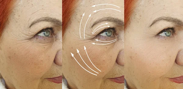 Elderly Woman Face Wrinkles Treatment Arrow — 스톡 사진