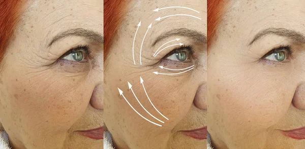 Elderly Woman Face Wrinkles Treatment Arrow — 스톡 사진