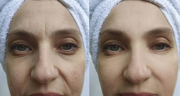 Wanita Wajah Keriput Dahi Sebelum Dan Setelah Pengobatan — Stok Foto