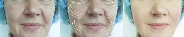 Woman Face Wrinkles Treatment Arrow — Stok fotoğraf