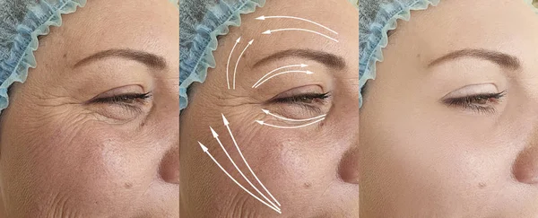 Woman Face Wrinkles Treatment Arrow — Stockfoto