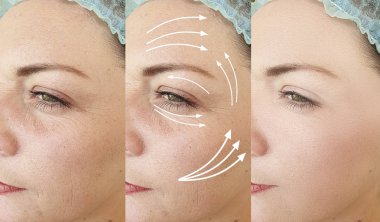 woman face wrinkles before and after treatment, arrow
