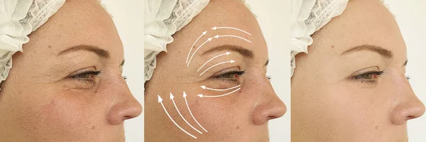 Woman Face Wrinkles Treatment Arrow — Stockfoto