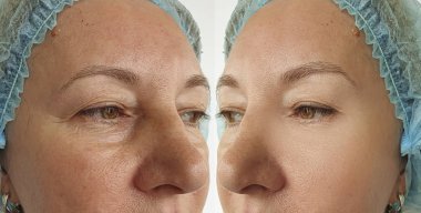 tedavi öncesi ve sonrası yaşlı kadın kırışıklıkları yüz