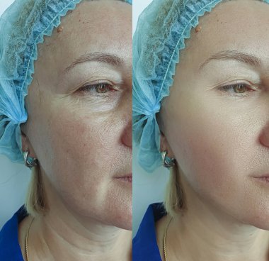 tedavi öncesi ve sonrası yaşlı kadın kırışıklıkları yüz