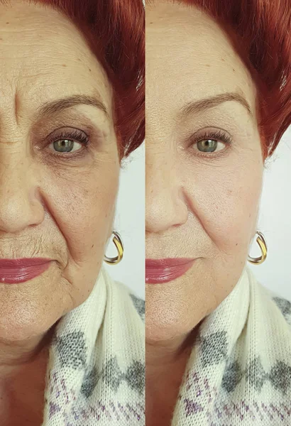 Face Old Woman Rynkor Före Och Efter Behandling — Stockfoto