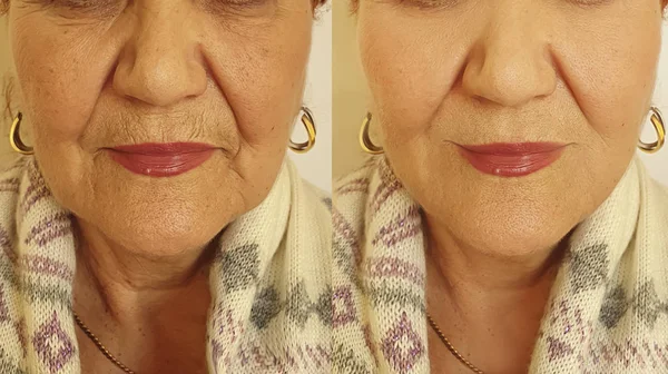 Cara Vieja Mujer Arrugas Antes Después Del Tratamiento —  Fotos de Stock