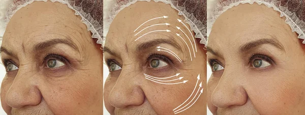 面对老年妇女治疗前后的皱纹 — 图库照片