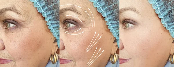 Лицо Пожилая Женщина Морщины После Лечения — стоковое фото