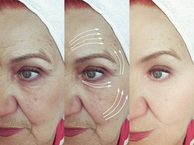 işlemden önce ve sonra yaşlı kadın yüz