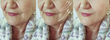 old woman wrinkles face before and after treatment arrow