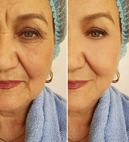 Wajah Wanita Tua Wajah Keriput Sebelum Dan Setelah Pengobatan — Stok Foto