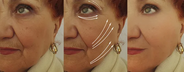 Alte Frau Falten Gesicht Vor Und Nach Der Behandlung Pfeil — Stockfoto