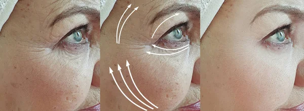 Old Woman Wrinkles Face Treatment Arrow — Stok fotoğraf