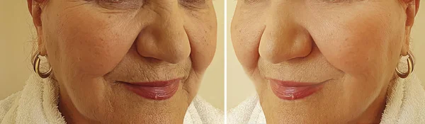 Γριά Γυναίκα Ρυτίδες Πρόσωπο Πριν Και Μετά Θεραπεία — Φωτογραφία Αρχείου