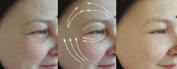 Frauenfalten Gesicht Vor Und Nach Der Behandlung — Stockfoto