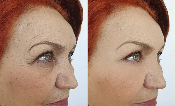 治疗前后老妇人皱纹的脸 — 图库照片
