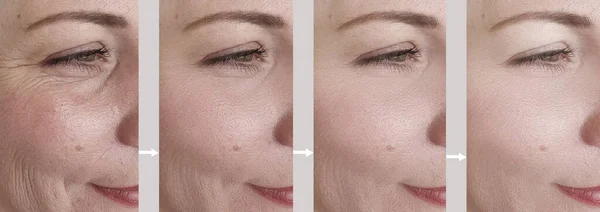 Arrugas Faciales Mujer Antes Después Del Tratamiento Collage — Foto de Stock