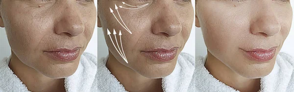 Woman Face Tightening — Stock Photo, Image