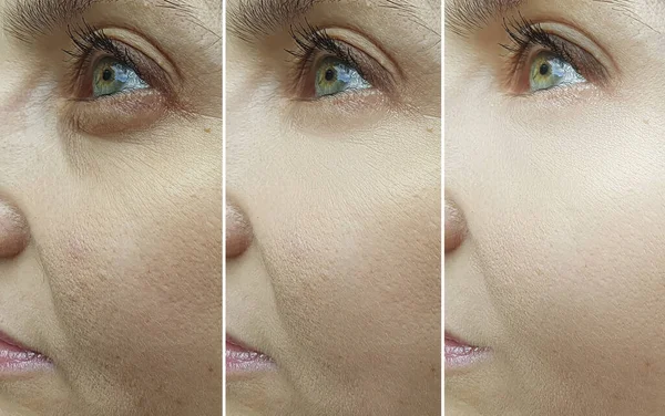Γυναίκα Πρόσωπο Ρυτίδες Πριν Και Μετά Θεραπεία Βλεφαροπλαστική — Φωτογραφία Αρχείου