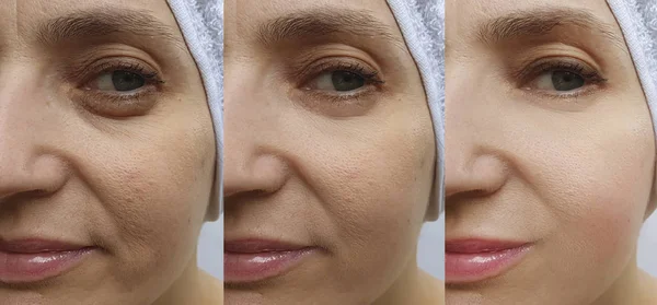 Arrugas Cara Mujer Antes Después Del Tratamiento Blefaroplastia — Foto de Stock
