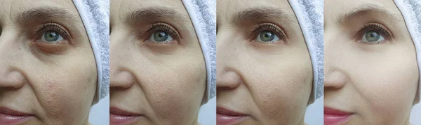 Falten Gesicht Der Frau Vor Und Nach Der Behandlung Blepharoplastik — Stockfoto