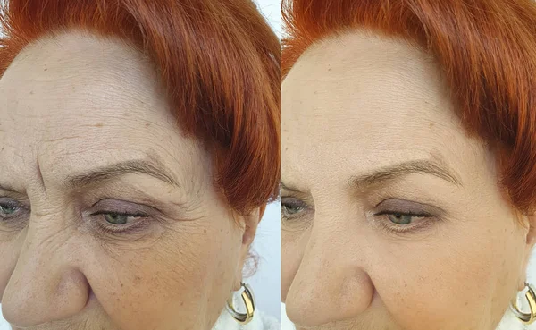 Πρόσωπο Γριά Γυναίκες Ρυτίδες Πριν Και Μετά Θεραπεία — Φωτογραφία Αρχείου