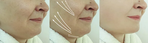 治疗前后面部女性皱纹 — 图库照片