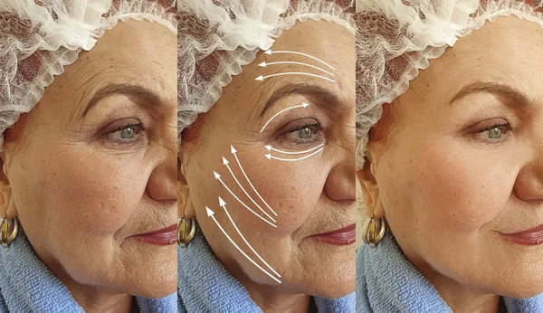 Ρυτιδωμένο Πρόσωπο Ηλικιωμένη Γυναίκα Πριν Και Μετά Θεραπεία — Φωτογραφία Αρχείου