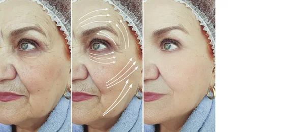 Kerut Wajah Wanita Tua Sebelum Dan Setelah Pengobatan — Stok Foto