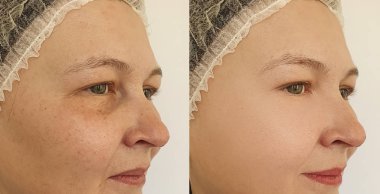 Kadın tedaviden önce ve sonra kırışıklıklarla karşılaşır