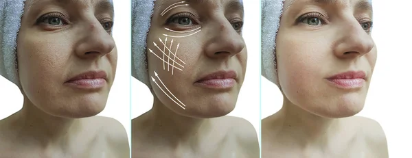 Woman Face Wrinkles Treatment Collage — Stock Photo, Image