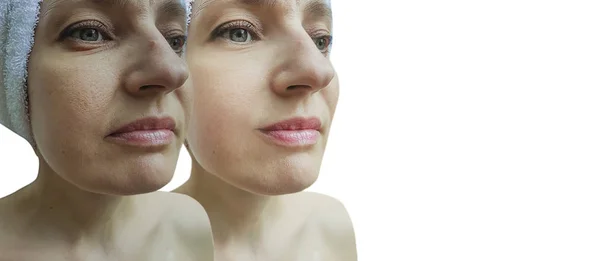 Морщины Лица Женщины После Лечения Коллаж — стоковое фото
