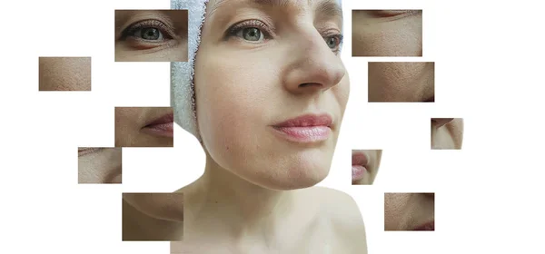 Frauengesichtsfalten Vor Und Nach Der Behandlung Collage — Stockfoto