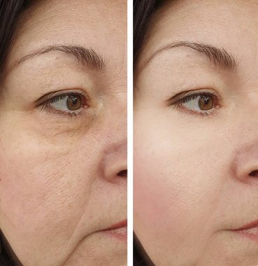 Kadın gözü tedaviden önce ve sonra kırışıyor.