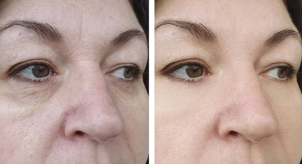 Γυναίκα Μάτια Ρυτίδες Πριν Και Μετά Θεραπεία — Φωτογραφία Αρχείου