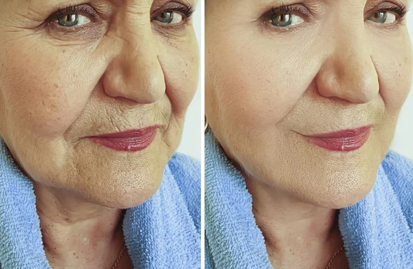 Tedavi Öncesi Sonrası Yaşlı Kadın Kırışıklıkları Yüz — Stok fotoğraf