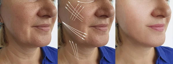 Face Old Woman Wrinkles Treatment Arrow — Stock Photo, Image