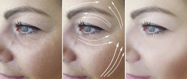 woman face wrinkles before and after treatment, arrow