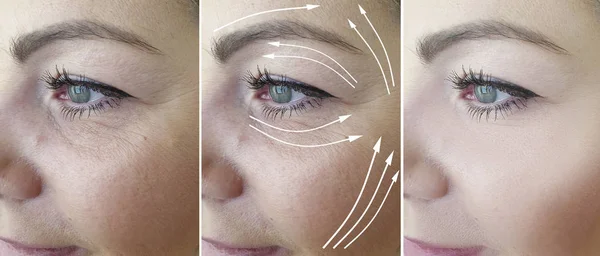 Woman Face Wrinkles Treatment Arrow — Stockfoto