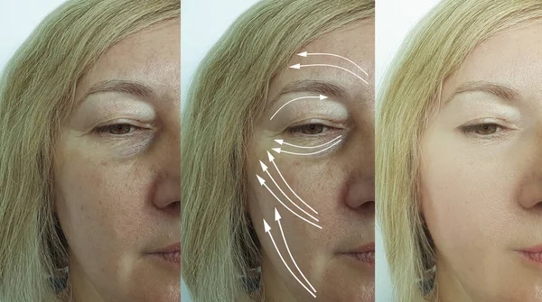 Wanita Wajah Keriput Sebelum Dan Setelah Pengobatan Panah — Stok Foto