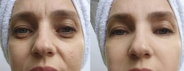 Kadın tedaviden önce ve sonra kırışıklıklarla karşılaşır