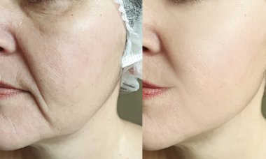 Kadın tedaviden önce ve sonra kırışıklıklarla karşılaşır