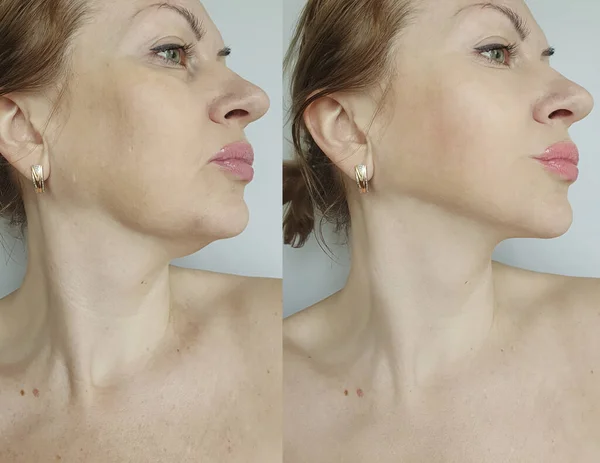 治療前と治療後の女性の二重あご — ストック写真
