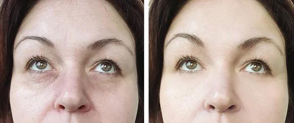 Ρυτιδωμένα Μάτια Προσώπου Γυναίκας Πριν Και Μετά Θεραπεία — Φωτογραφία Αρχείου